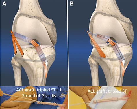 acl reconstruction testing procedure